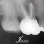고덕동 치과 에서 신경치료 받은 치아 뿌리 끝 염증 지켜보다가 보험 임플란트 해드린 과정
