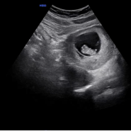 [임신기록] 임신초기 8주차,9주차증상 , 입덧시작 ,젤리곰, 심장박동수