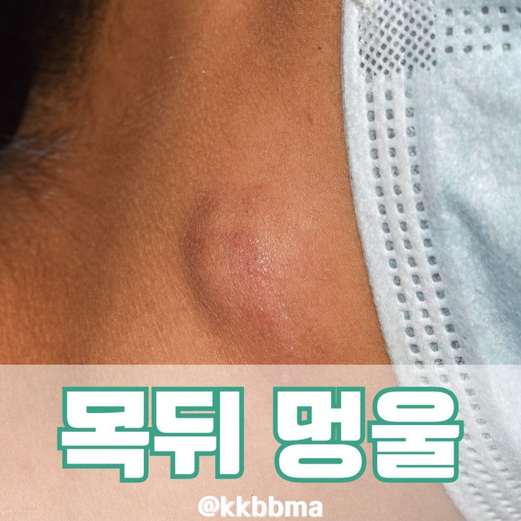 목 뒤 멍울 지방종 통증 얼마나 심하면 병원 가야될까? : 네이버 블로그