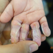 화상 물집 생겼을때, 아기 손가락 화상 치료 사례 (가열식 가습기)