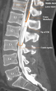 요추 CT xray 요추 엑스레이 검사 하는 이유, 장점과 단점 방법 각 영상 촬영 검사의 주의사항 및 부작용 까지 : 네이버 블로그