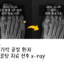 새끼 발가락 골절 깁스 환자의 회복 이야기, 접골탕 치료 전후 x-ray