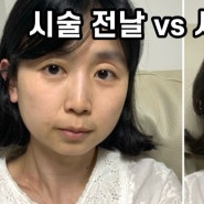 강남 피부탄력 볼링크(슈링크+볼뉴머) 효과 본 솔직 후기