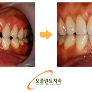 임플란트 치료 전 반드시 보호해야 하는 영구치!