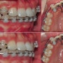 설측 치아교정기를 이용한 성인 돌출입 재교정:치근흡수 줄이기