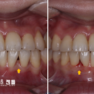[블랙트라이앵글 레진 / 치과더젠틀] 치아교정 후에 남아 있는 앞니 블랙트라이앵글(블트)을 레진 치료로 개선한 증례.
