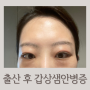출산 후 그레이브스병 (갑상선 항진증) 안병증 눈 치료기 눈꺼풀 스테로이드 후기