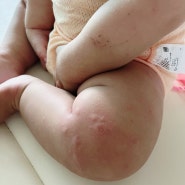 12개월 13개월 아기 두드러기 돌 예방접종 부작용?! (일본뇌염)