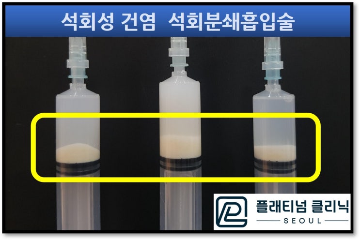 (강남어깨병원, 플래티넘의원) 극심한 어깨 통증, 어깨석회성건염. 의사도 치료 받는 비수술적 방법은?