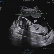 임신15,16주차) 아기성별 공개, 하품하는 초음파