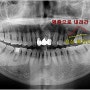 신당동 치과 고름으로 소실된 뼈는 임플란트 뼈이식을 통해 치료할 수 있습니다!
