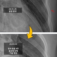 갈비뼈 금갔을 때 증상 치료 및 감별해야 할 응급 질환, 도움되는 음식은?