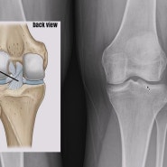 [십자인대파열] 날아라정형외과 부원장이 직접 말하는 수술 후기