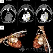 악성 대동맥소체종양(Aortic Body Tumor) 치료 증례: 수술적 제거, 심낭절제술 및 PDST를 이용한 항암치료