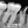 수정구 치과 추천 부러진 어금니 치아 파절 수면마취 후 즉시 디지털 임플란트 식립