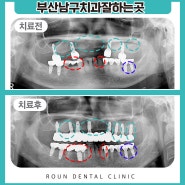 부산남구치과잘하는곳, 틀니가 불편하다면?