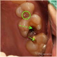산본역치과 치아 파절 되었다고 성급하게 크라운치료? 아닐 수 있는 '이유'