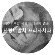 광교 수원 사랑니치과 30대 후반 염증 치관주위염 통증 유발 아래 매복 사랑니발치