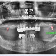 종로 5가 치과 치조골 소실로 이식술 동반해서 임플란트 한 사례