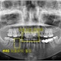 송현동 치과 치아 교정 후 임플란트 수술을 받을 수 있을까요?