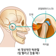 [부산턱관절치과] 턱이 뻐근해요, 턱에서 소리가 나요