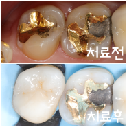 깊은 충치를 신경치료 없이 세라믹 온레이로 치료한 사례