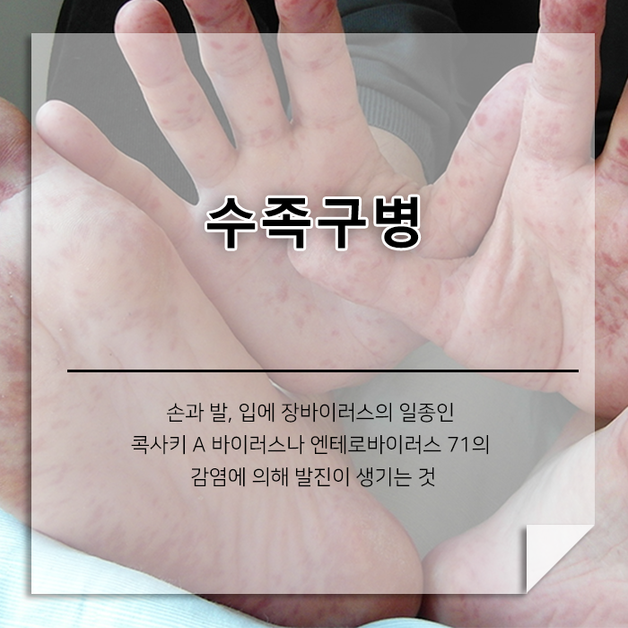 손, 발, 입에 생기는 작은 수포 수족구병 : 네이버 블로그