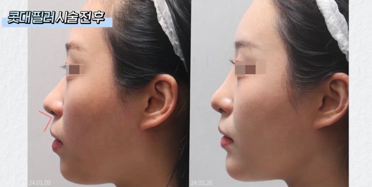 코 수술은 무섭다구요? 수술없이 코 필러로 감쪽같이 예뻐지기! : 네이버 블로그