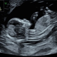나의 임신 기록 (초기~18주)
