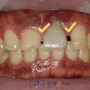 "앞니 사이가 벌어졌어요" 신길동 치과 치간이개수복(Diastema closure) 레진치료