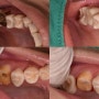 MIH 태어나면서부터 치아가 약한 환자, 오래된 금니 교체 지르코니아 크라운 어금니 사례