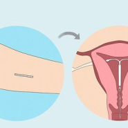 임플라논 제거 시술 주의사항 및 부작용, 가임기 임신가능 여부 기간 관련 정보