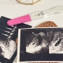 대표적인 임신 극초기증상 생리 전 임신 착상혈 시기 임신초기증상