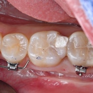 교정치료 중 인접면 충치로 인한 치아파절, 레진빌드업으로 자연치아 살리기