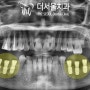 외국인 진료 가능한 성남 치과 추천 한다면 더서울이 답입니다. "Dental treatment for foreigners is possible."