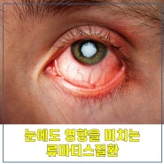 눈에도 영향을 미치는 류마티스질환