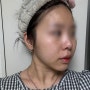 [잠실여드름] 피부과모공관리 여드름자국레이저 BBL쥴레이저, 뉴아꼴레이드 받은 후기