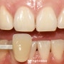 송도동 치과 이를 밝게 해주는 치아미백 종류, 과정, 전후 비교, 주의사항