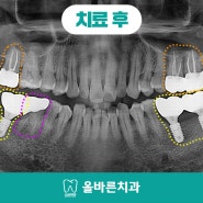 율하동치과잘하는곳 양측임플란트로 편안한 식사를