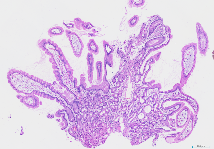 Heterotopic Gastric Mucosa, Duodenum : 네이버 블로그