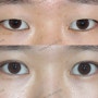 비대칭 눈매와 안검하수로 보여지는 경우에서 눈매교정없이 절개로 시행한 20대 여성