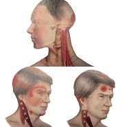 얼굴 틀어짐(사경증) 중요근육, 목빗근(흉쇄유돌근, Sterocleidomastoid)