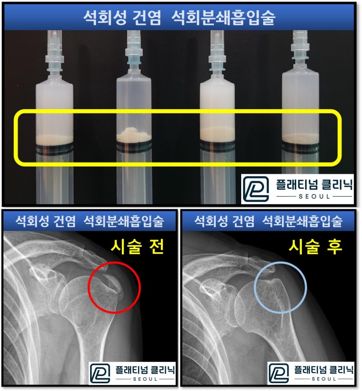 (강남어깨병원. 플래티넘의원) 어깨 석회성 건염. 석회분쇄흡입술 아무데서나 받지 마세요. 더 아파질수도...