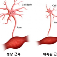 근위축성 가쪽경화증, 루게릭병