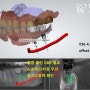 수정구 치과 에서 왼쪽 아래 어금니 부러진 잔존 치근 발치 후 디지털 임플란트 로 저작 기능 개선한 과정