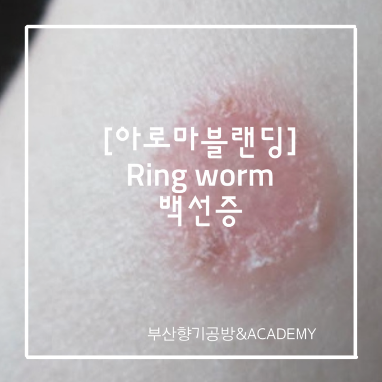 Aromatic Blending of Essential oil 아로마블랜딩 39, Ringworm (백선증) 아로마테라피 국제 ...