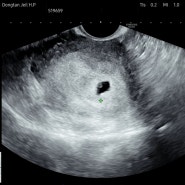 [난임 일기] 배아 이식 후, 임테기 역전! 첫 초음파와 입덧 증상 +피비침