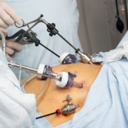 비만 대사 수술 종류 별 장점 부작용, 절차 및 과정