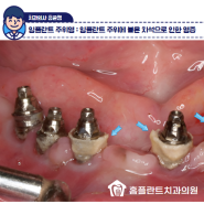 임플란트 스케일링이 필요한 이유