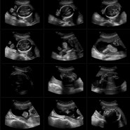 임신22주차) 정밀초음파 검사, 아기손&아기발